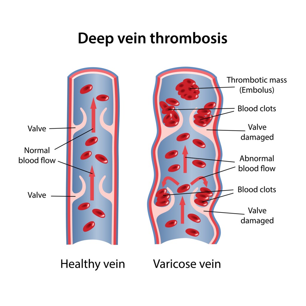 Slate Dvt Example Another Anniversary of Sorts #DVT #BloodClot - Bonnie Reads and Writes